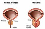 Best prostate cancer surgeons in michigan - A prosztatagyull